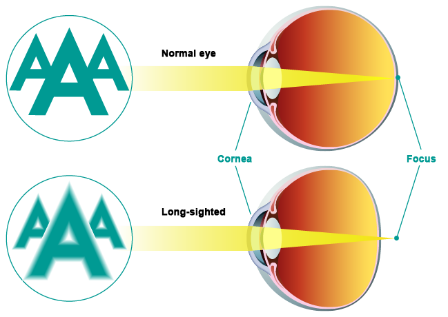 Long sightedness Gemini Augenlaser International