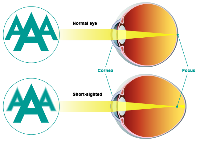 Can You Be Short-sighted in One Eye and Long-sighted in the Other?